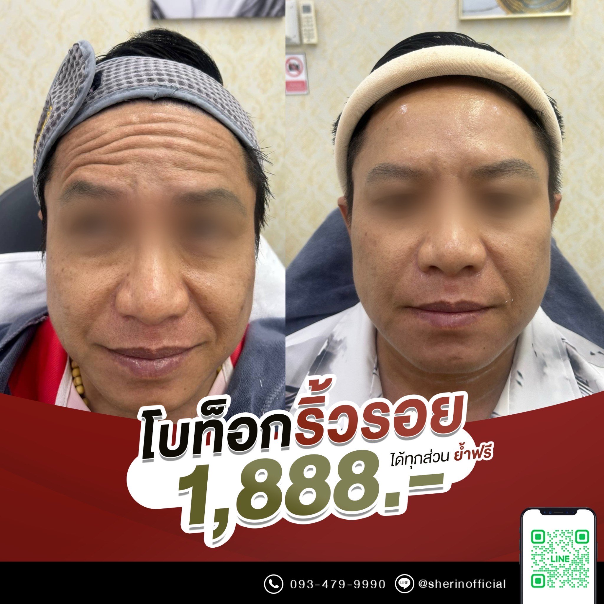 โบท็อกริ้วรอย เหมาจุด